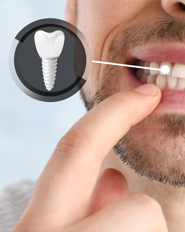 wcu dental implant Home2