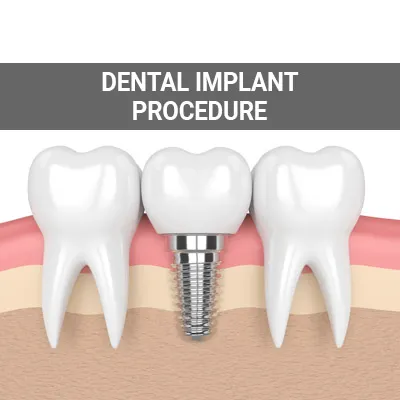 dental implant procedure nav Services Page Template